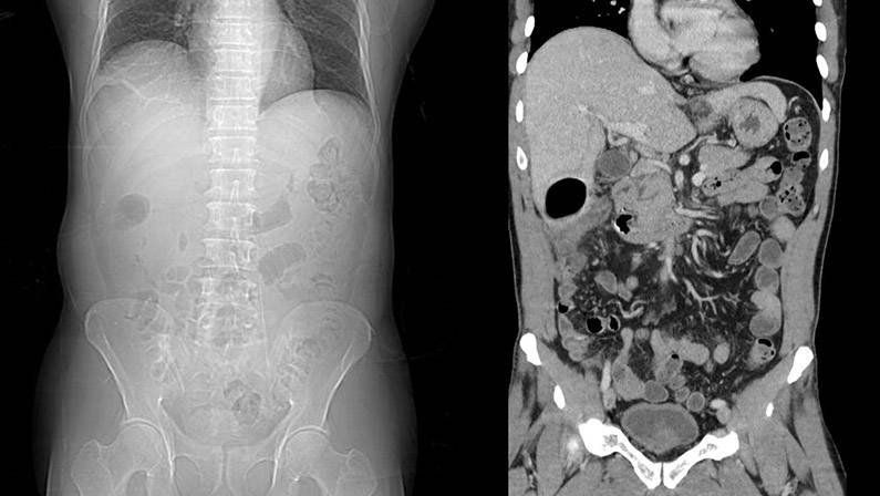 CT Scan, Abdomen CT, CAT Scan, ABD