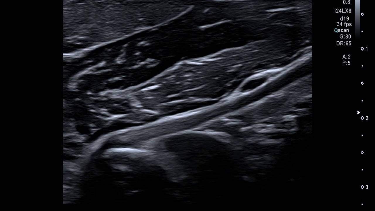 ultrasound